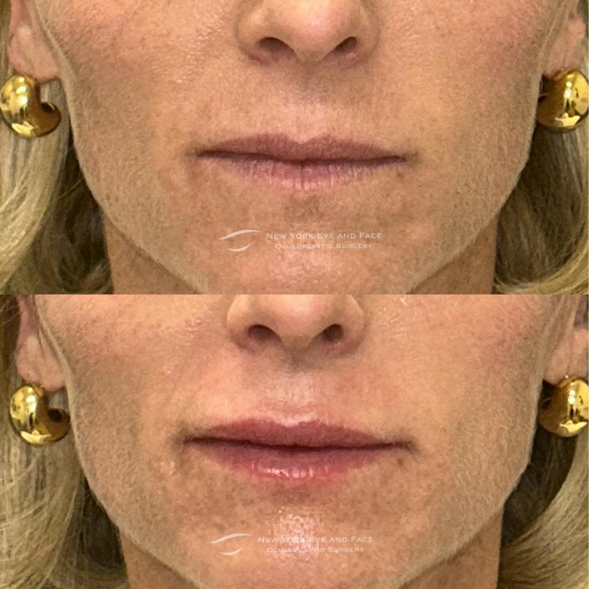 Lip Fillers Before & After Gallery - Patient 378589 - Image 1