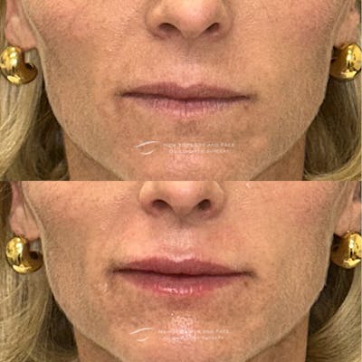 Lip Fillers Before & After Gallery - Patient 378589 - Image 1