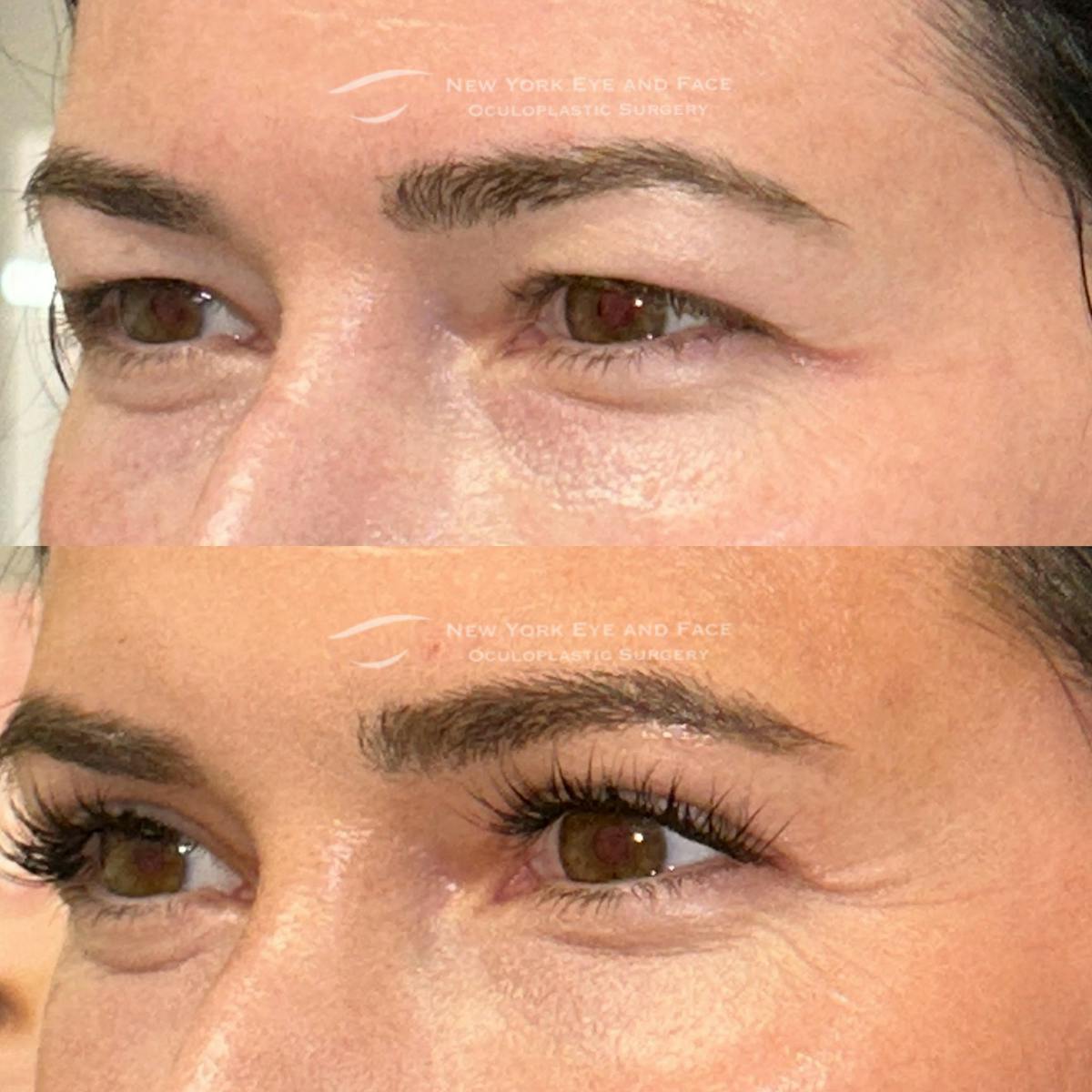 Upper Blepharoplasty Before & After Gallery - Patient 269328 - Image 3