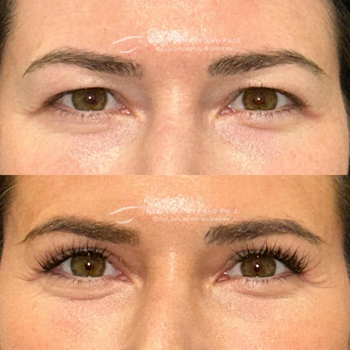 Upper Blepharoplasty Before & After Gallery - Patient 269328 - Image 1