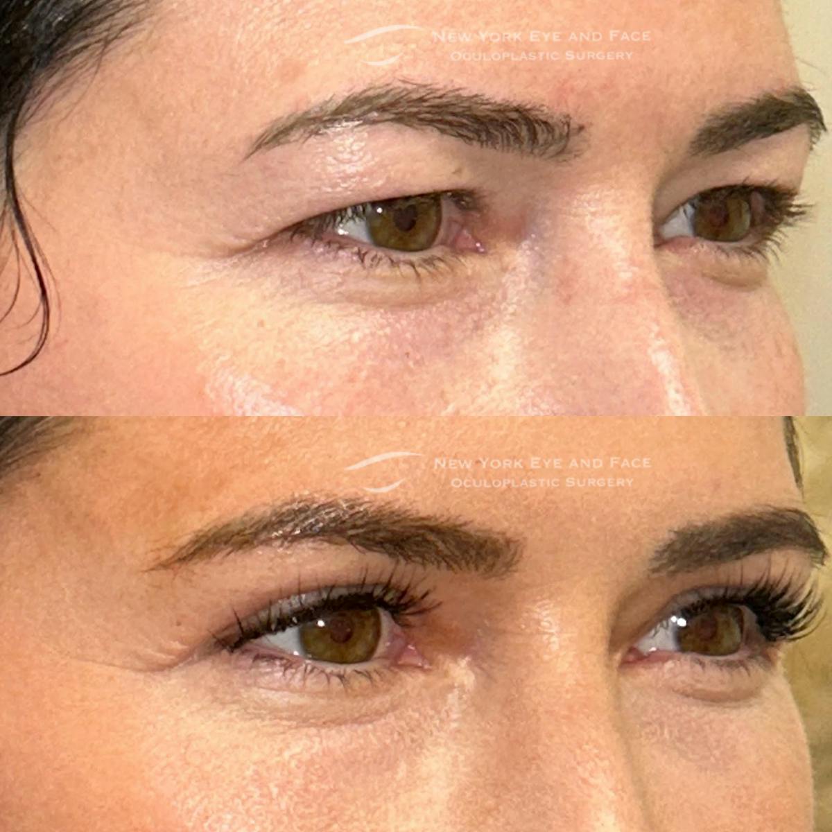 Upper Blepharoplasty Before & After Gallery - Patient 269328 - Image 2