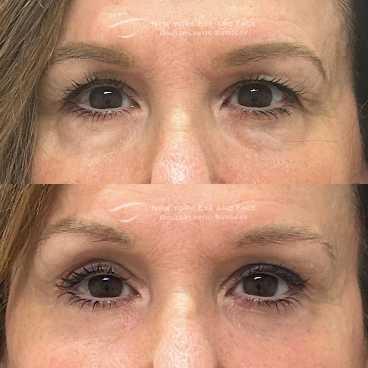 Upper Blepharoplasty Before & After Gallery - Patient 193436 - Image 1