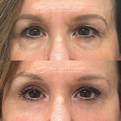 Upper Blepharoplasty Before & After Gallery - Patient 193436 - Image 1