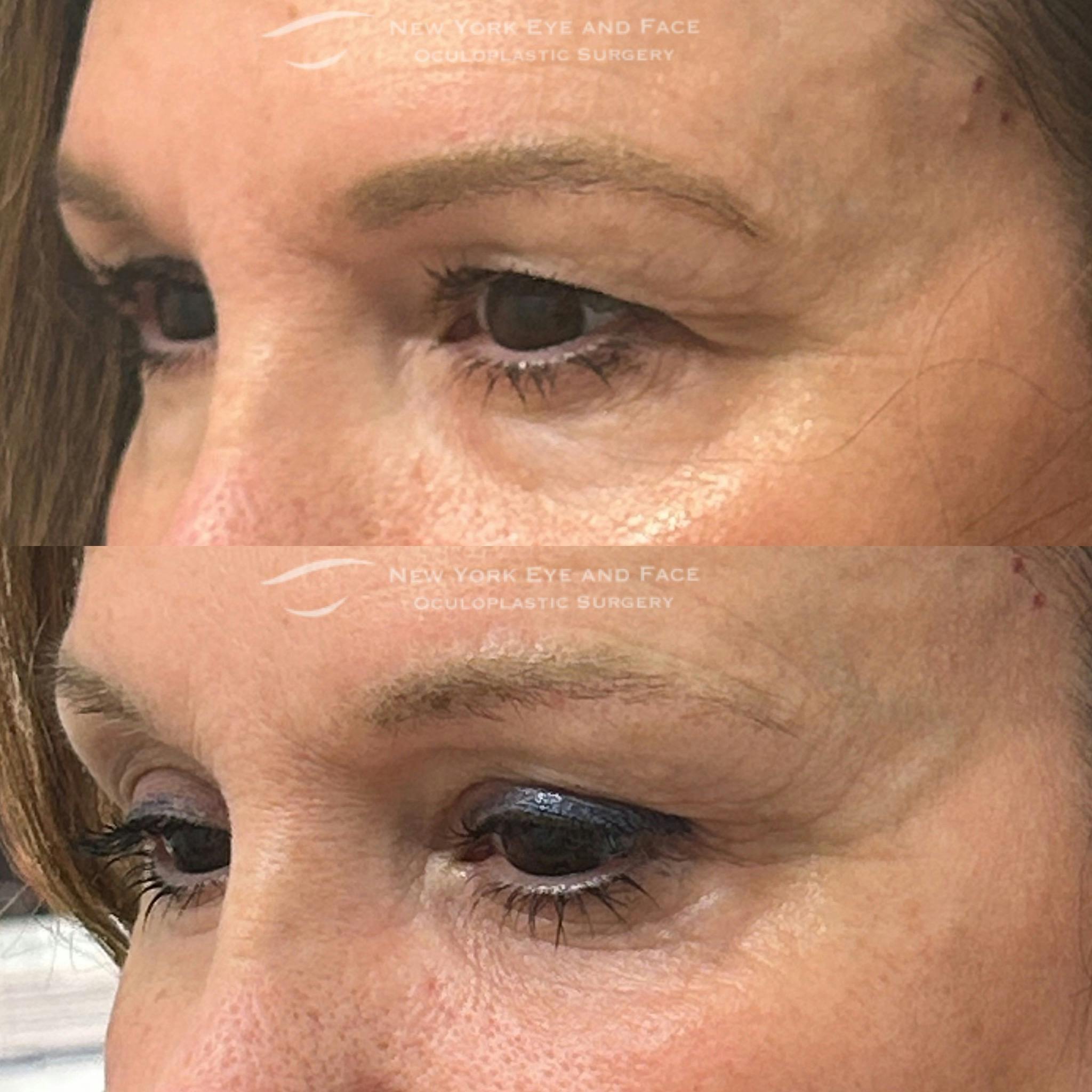 Tear Trough Deformity Repair Before & After Gallery - Patient 399160 - Image 3