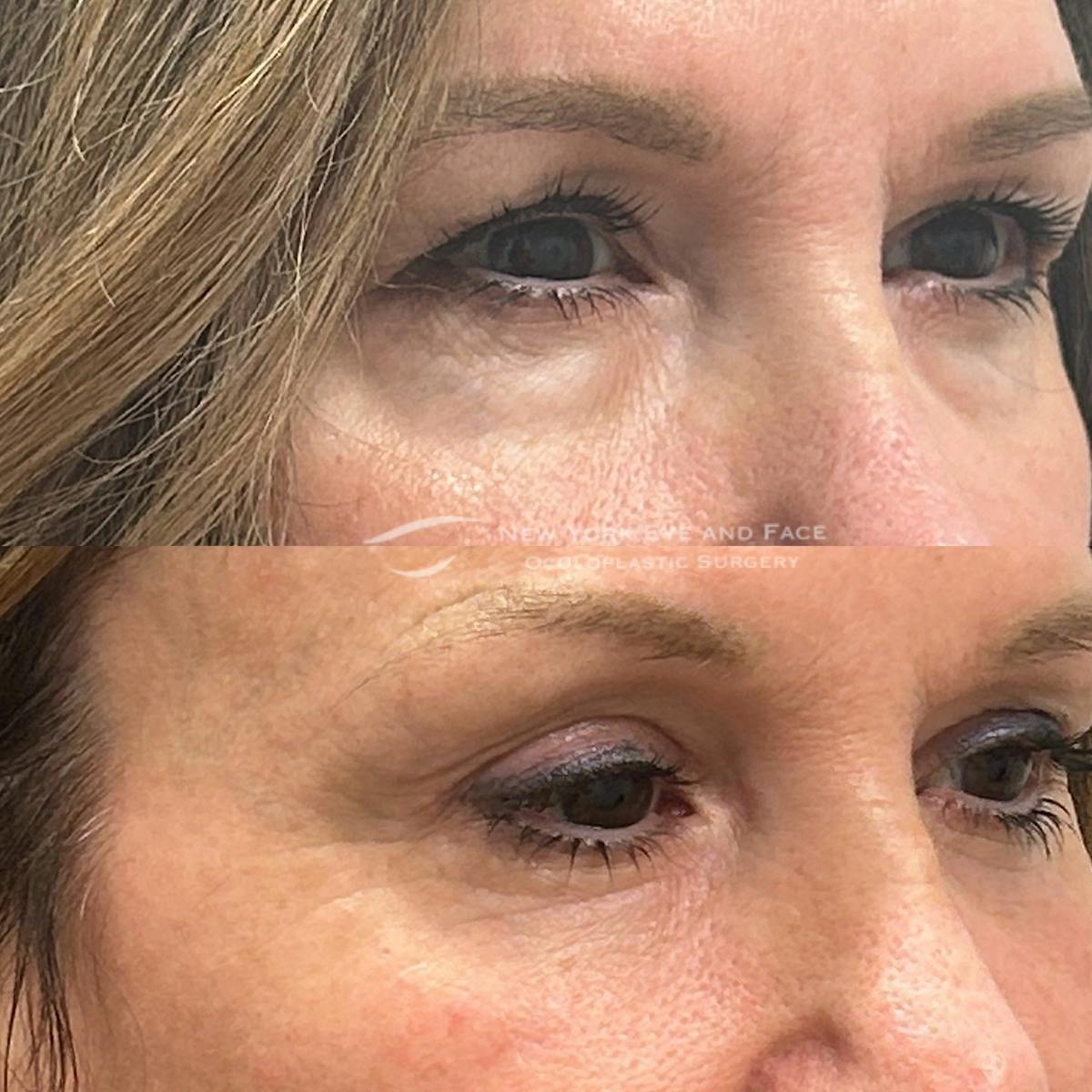 Upper Blepharoplasty Before & After Gallery - Patient 193436 - Image 2