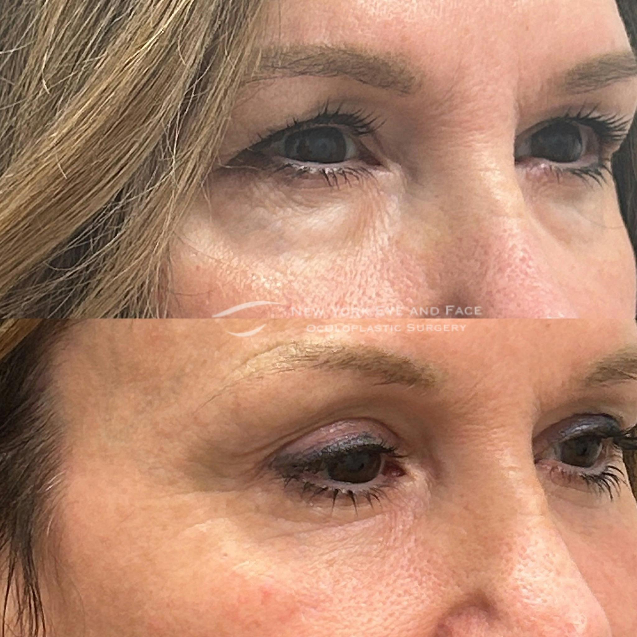 Tear Trough Deformity Repair Before & After Gallery - Patient 399160 - Image 2