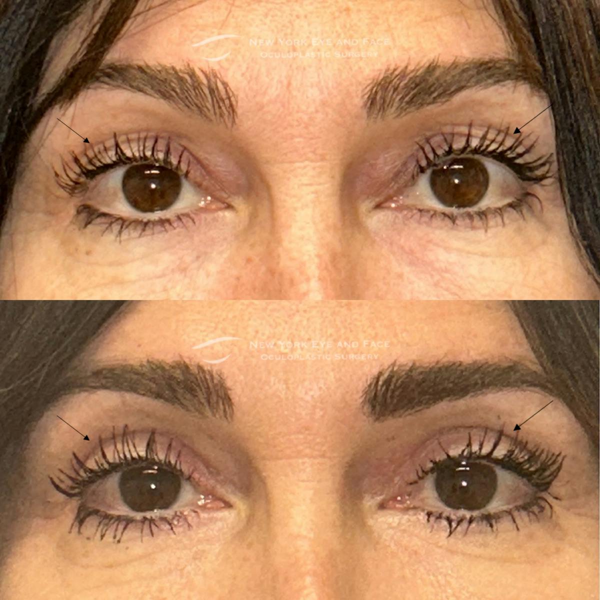 Upper Blepharoplasty Before & After Gallery - Patient 362207 - Image 1