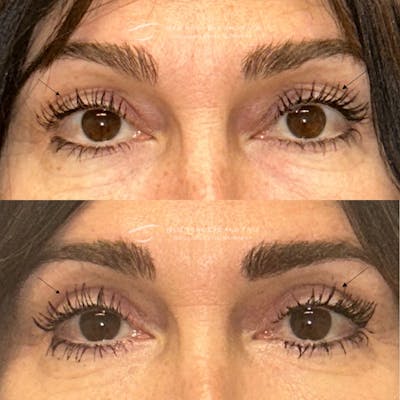 Upper Blepharoplasty Before & After Gallery - Patient 362207 - Image 1