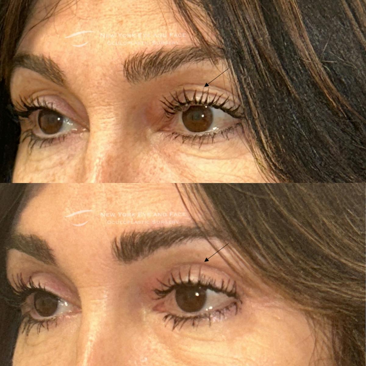 Upper Blepharoplasty Before & After Gallery - Patient 362207 - Image 3