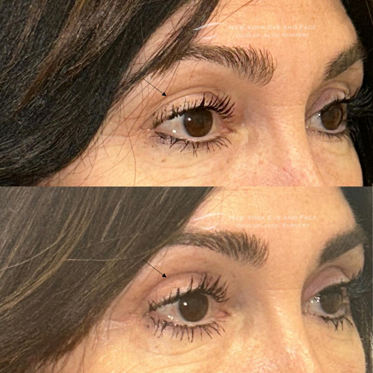 Upper Blepharoplasty Before & After Gallery - Patient 362207 - Image 2