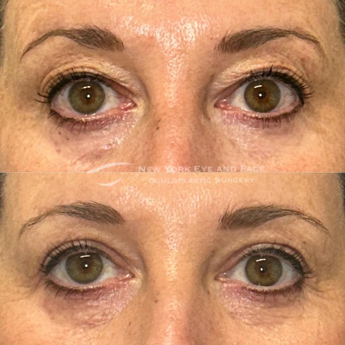 Upper Blepharoplasty Before & After Gallery - Patient 151716 - Image 1