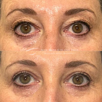 Upper Blepharoplasty Before & After Gallery - Patient 151716 - Image 1
