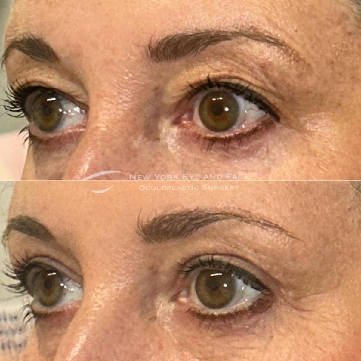 Upper Blepharoplasty Before & After Gallery - Patient 151716 - Image 3