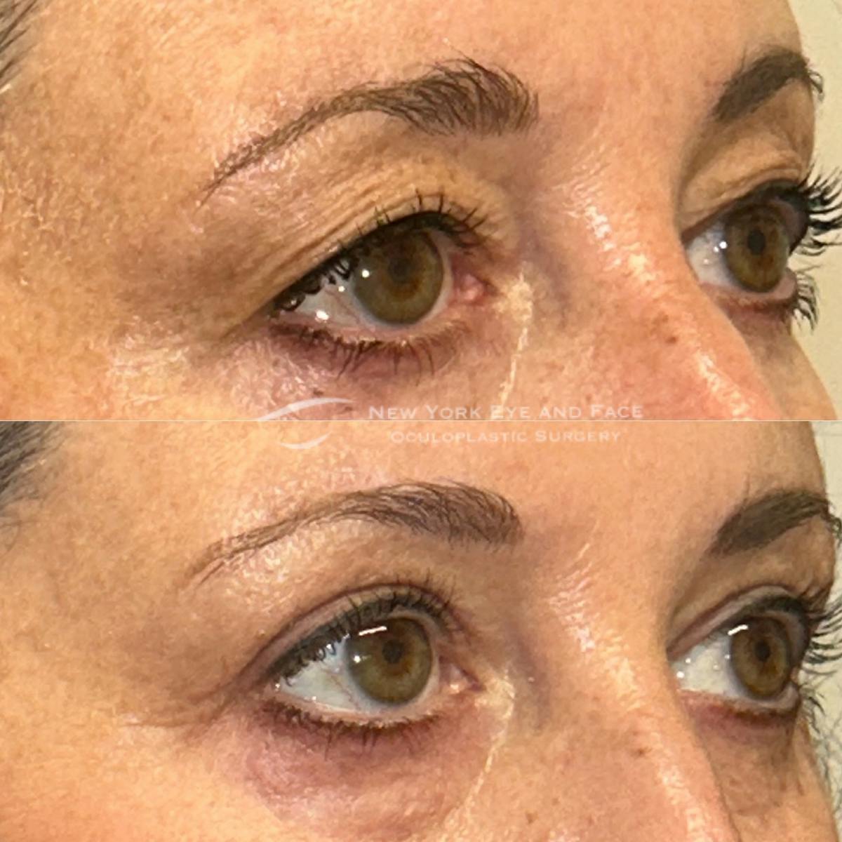 Upper Blepharoplasty Before & After Gallery - Patient 151716 - Image 2