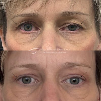 Upper Blepharoplasty Before & After Gallery - Patient 293331 - Image 1