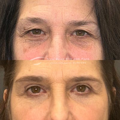 Upper Blepharoplasty Before & After Gallery - Patient 419766 - Image 1