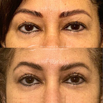 Upper Blepharoplasty Before & After Gallery - Patient 228301 - Image 1