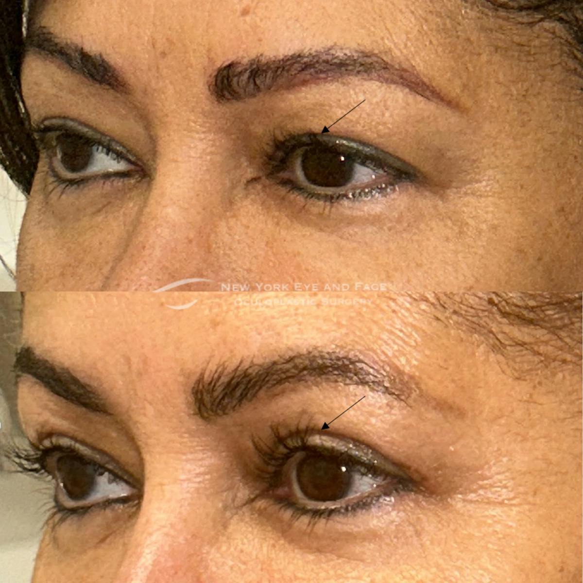 Upper Blepharoplasty Before & After Gallery - Patient 228301 - Image 3