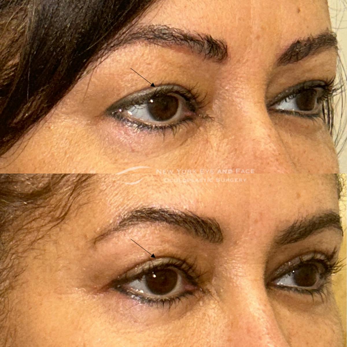 Upper Blepharoplasty Before & After Gallery - Patient 228301 - Image 2