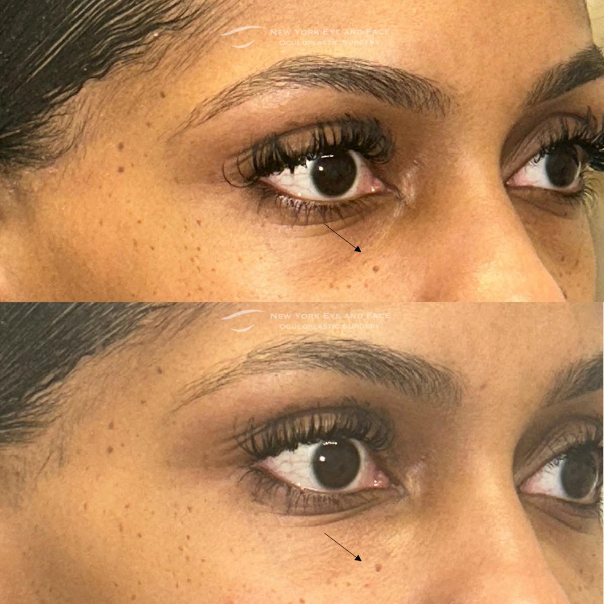 Dermal Fillers Before & After Gallery - Patient 318635 - Image 3