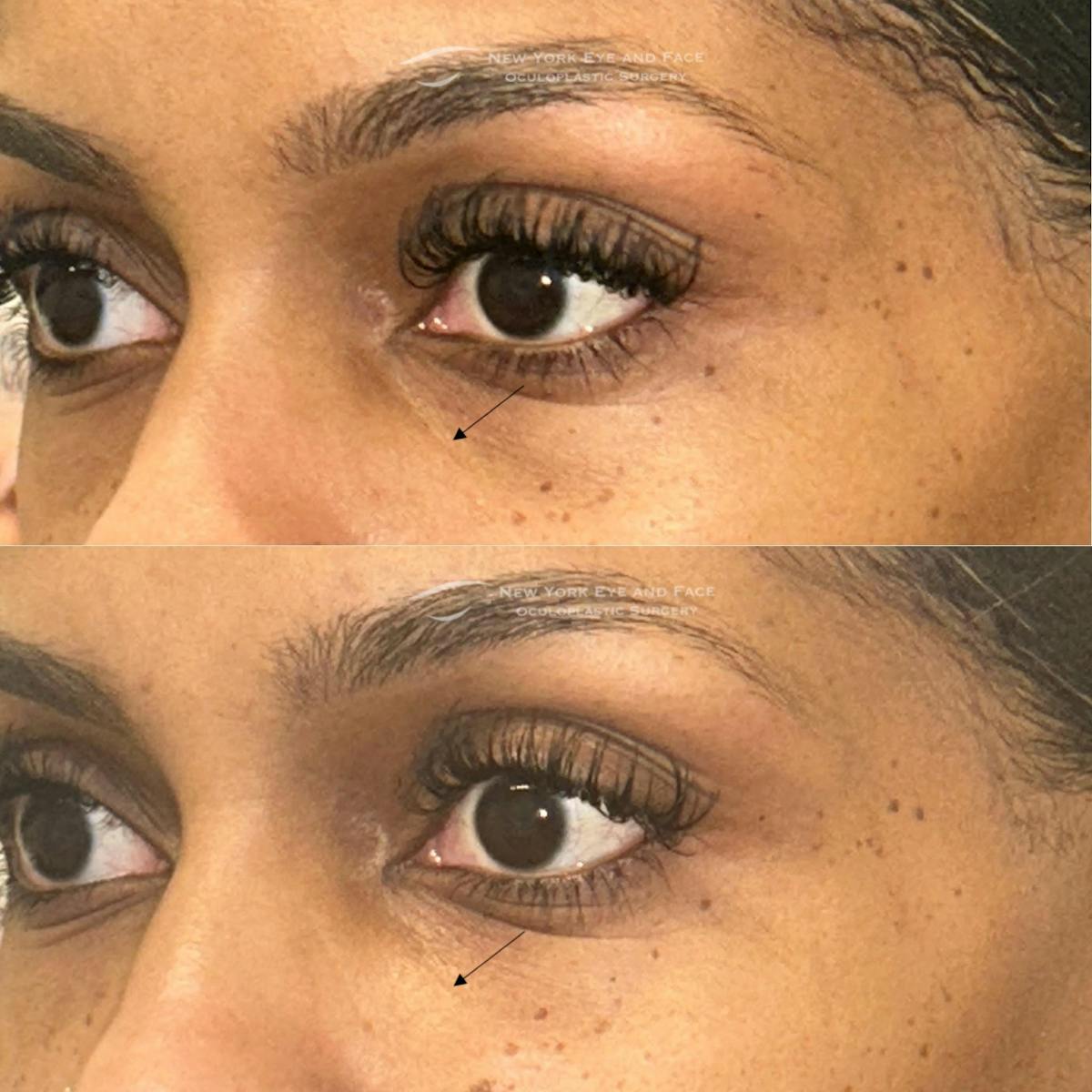 Dermal Fillers Before & After Gallery - Patient 318635 - Image 2