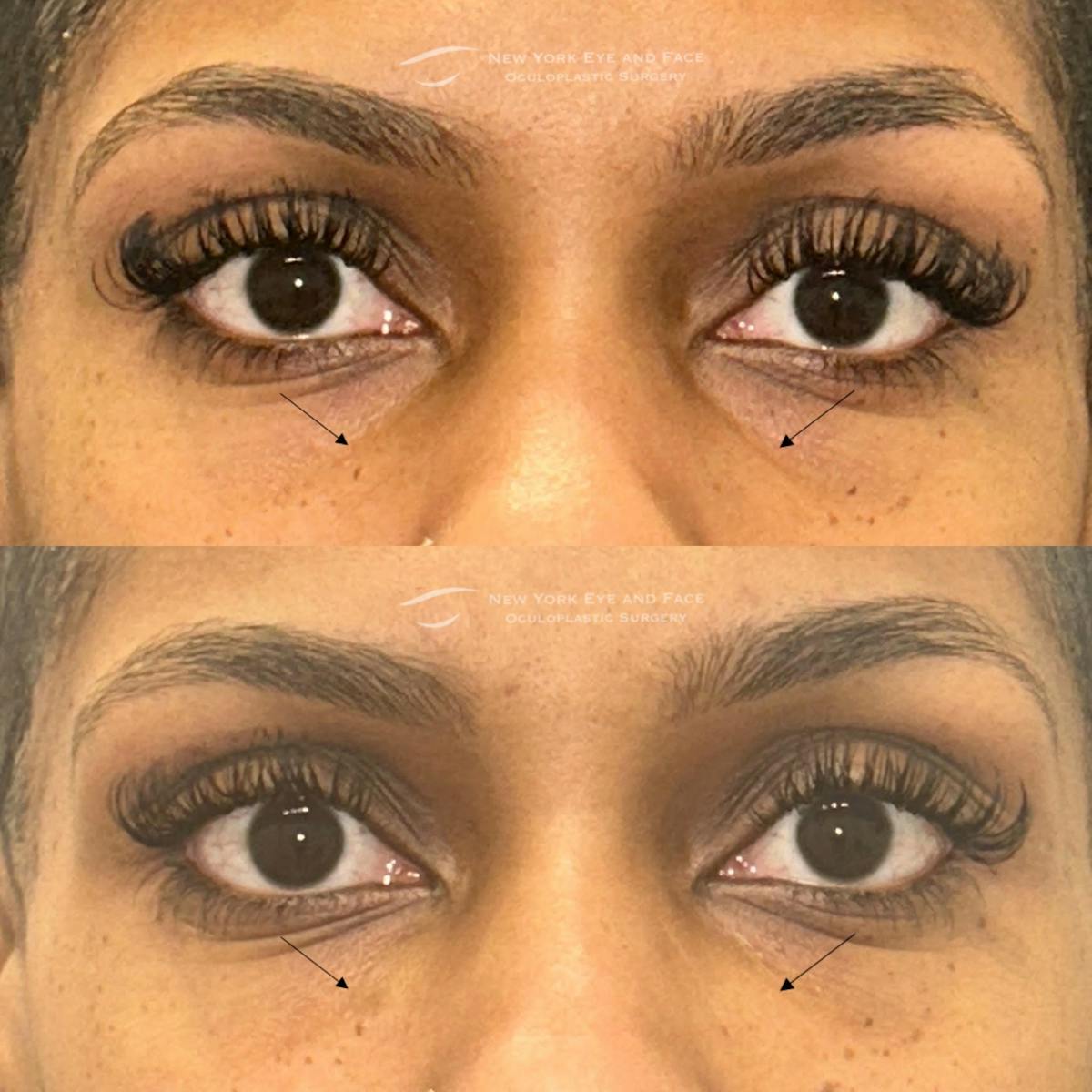 Dermal Fillers Before & After Gallery - Patient 318635 - Image 1