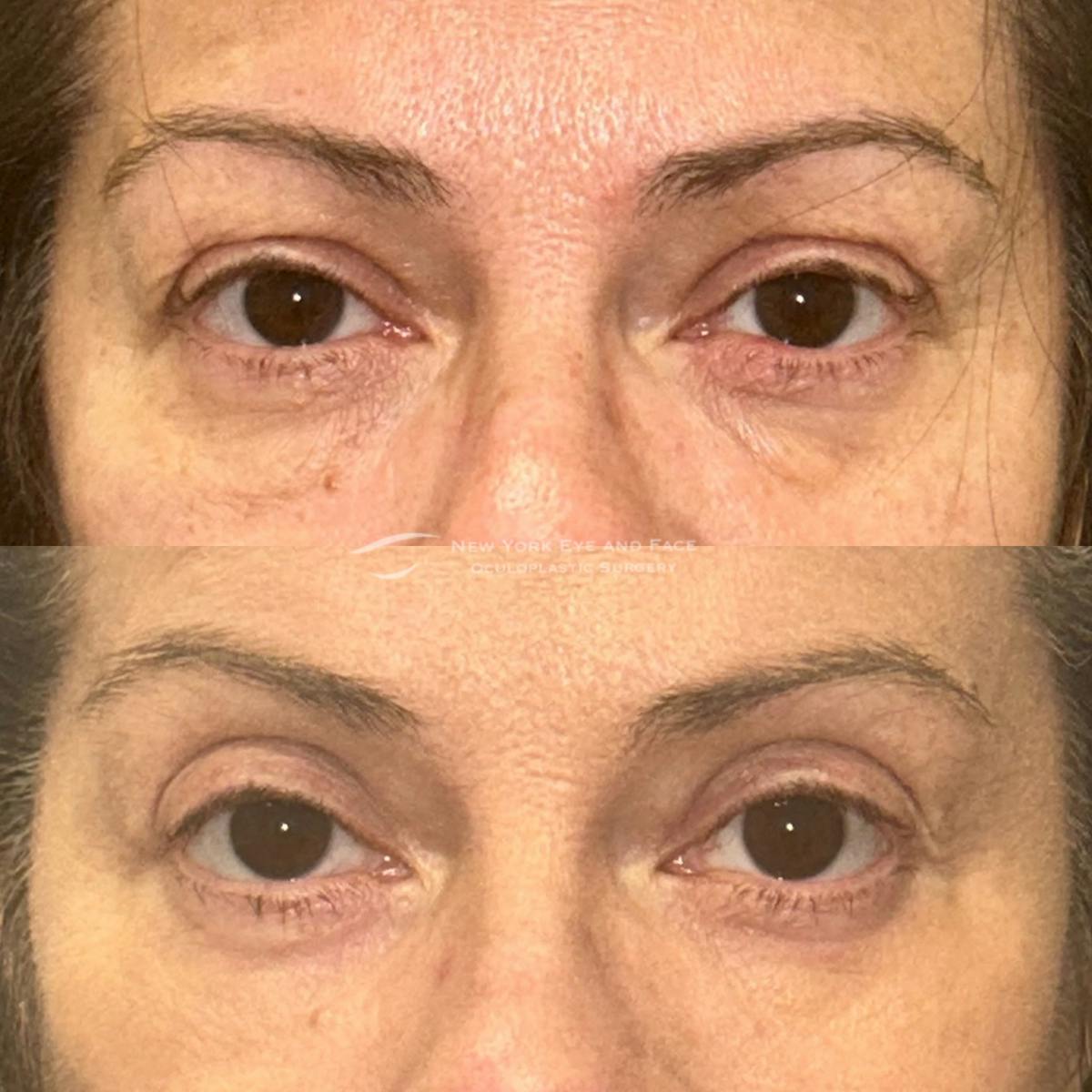 Upper Blepharoplasty Before & After Gallery - Patient 505143 - Image 1