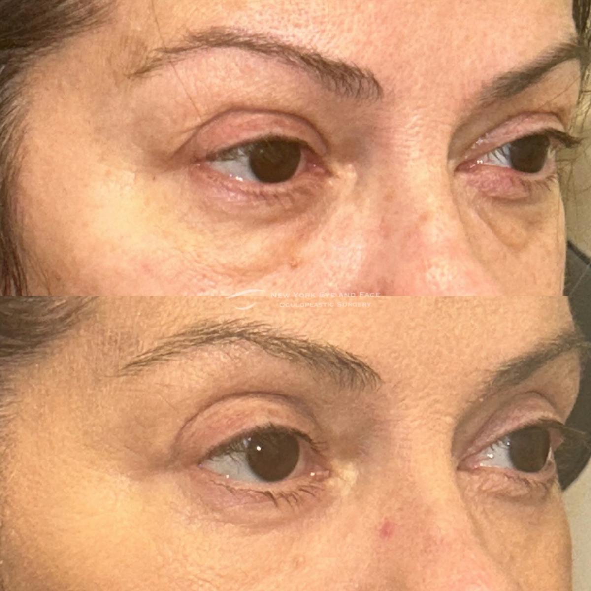 Upper Blepharoplasty Before & After Gallery - Patient 505143 - Image 2