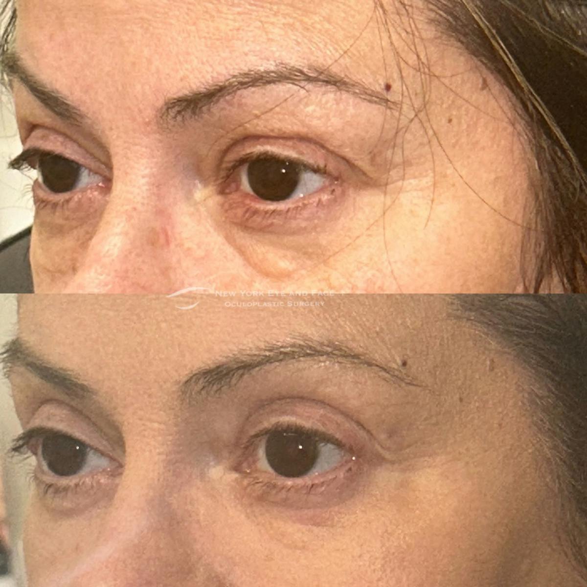 Upper Blepharoplasty Before & After Gallery - Patient 505143 - Image 3