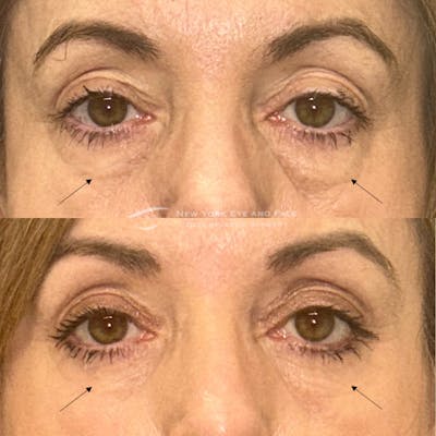 Lower Blepharoplasty Before & After Gallery - Patient 188862 - Image 1