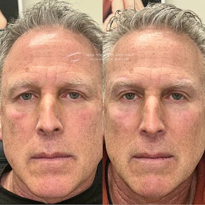 Brow Lift Before & After Gallery - Patient 261815 - Image 1