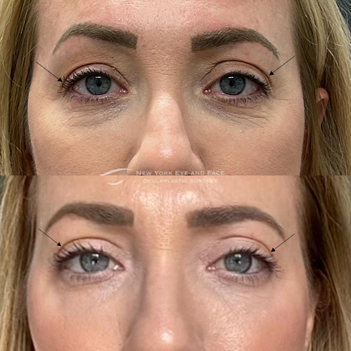 Upper Blepharoplasty Before & After Gallery - Patient 323124 - Image 1