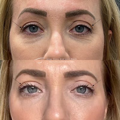 Upper Blepharoplasty Before & After Gallery - Patient 323124 - Image 1
