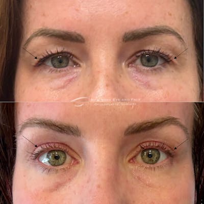 Brow Lift Before & After Gallery - Patient 547779 - Image 1