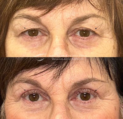 Upper Blepharoplasty Before & After Gallery - Patient 816069 - Image 1