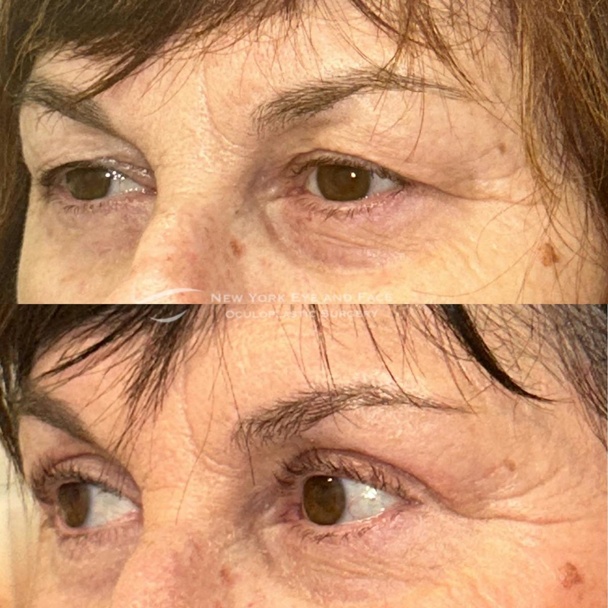 Upper Blepharoplasty Before & After Gallery - Patient 816069 - Image 3