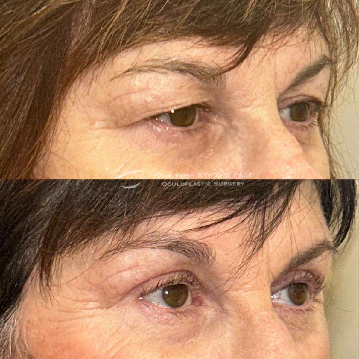 Upper Blepharoplasty Before & After Gallery - Patient 816069 - Image 2