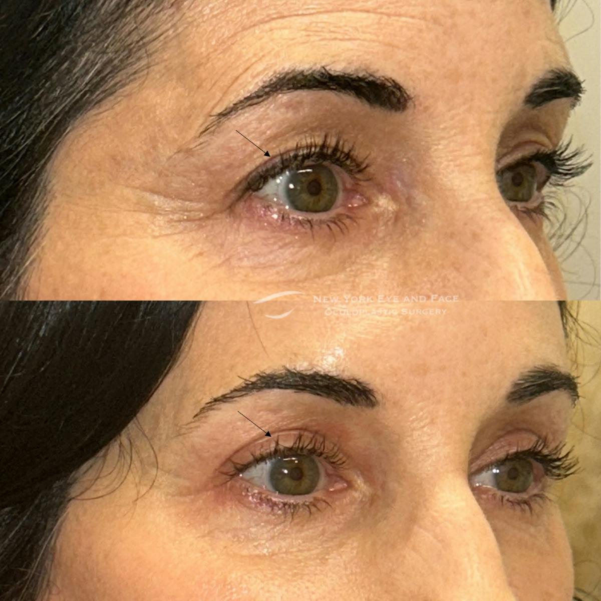 Upper Blepharoplasty Before & After Gallery - Patient 232943 - Image 2