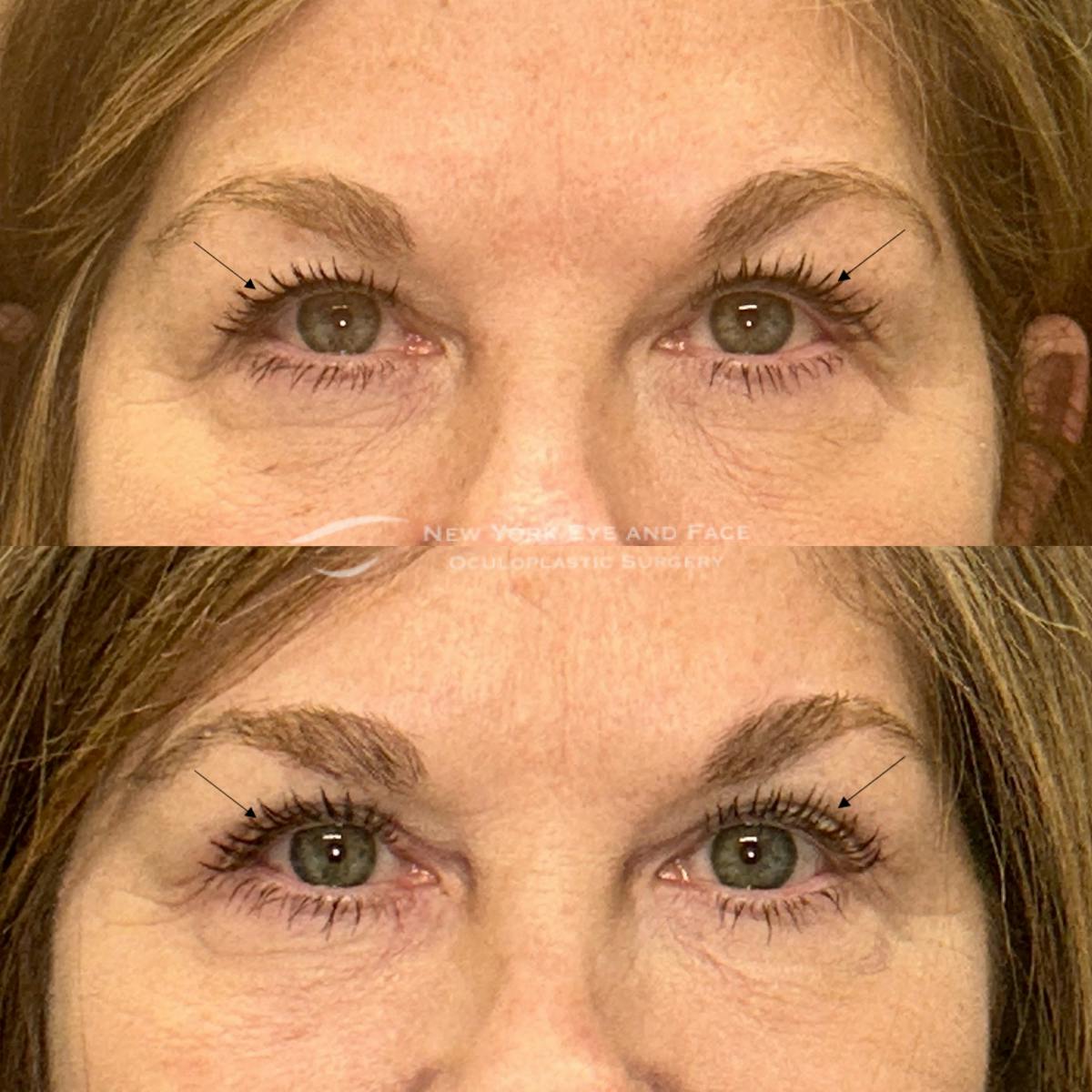 Upper Blepharoplasty Before & After Gallery - Patient 382909 - Image 1