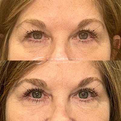 Upper Blepharoplasty Before & After Gallery - Patient 382909 - Image 1