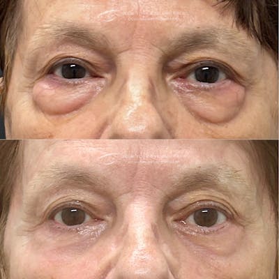 Lower Blepharoplasty Before & After Gallery - Patient 377237 - Image 1