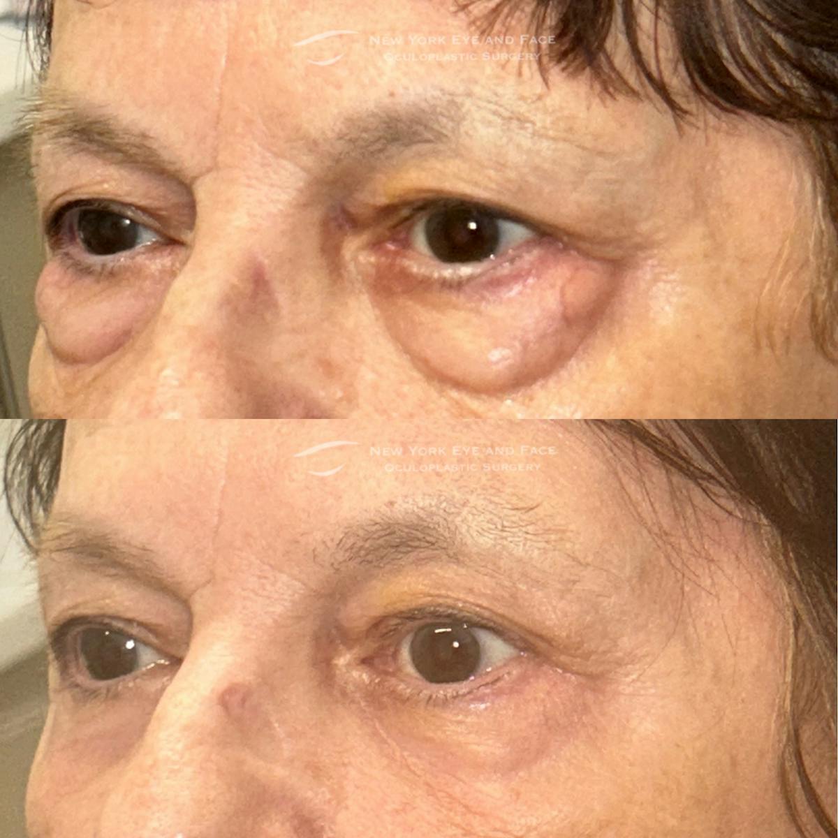 AcuPulse CO2 Laser Before & After Gallery - Patient 246085 - Image 2