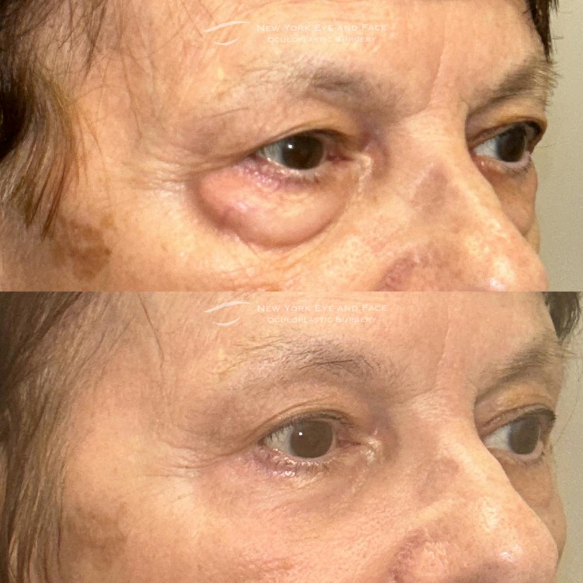 AcuPulse CO2 Laser Before & After Gallery - Patient 246085 - Image 3