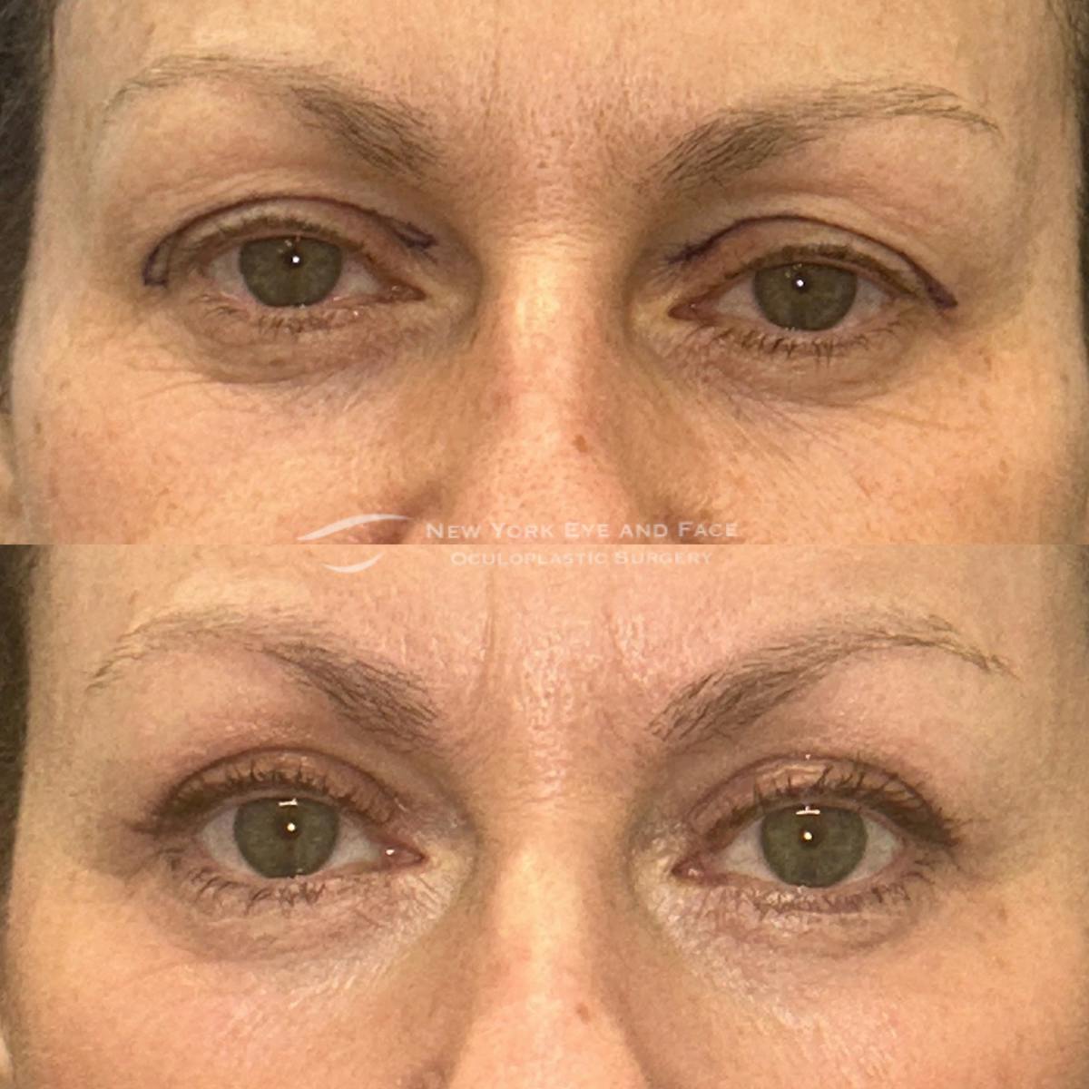 AcuPulse CO2 Laser Before & After Gallery - Patient 237285 - Image 1