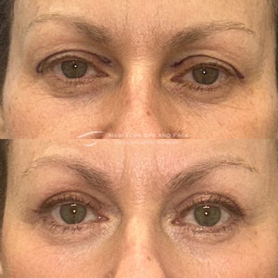 Upper Blepharoplasty Before & After Gallery - Patient 262615 - Image 1