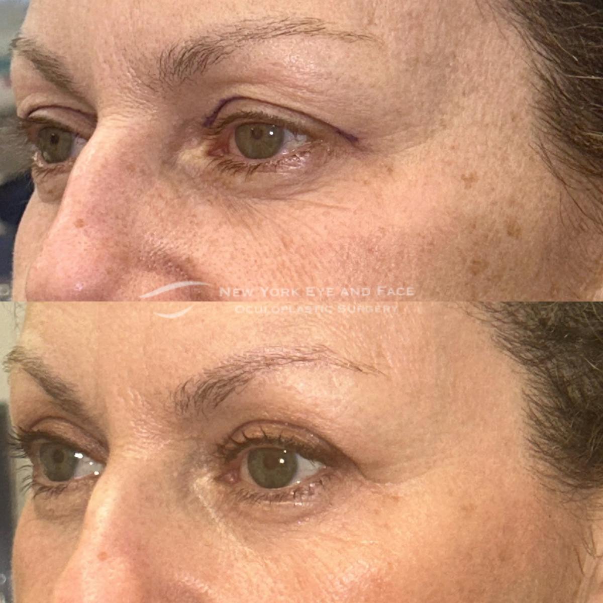 AcuPulse CO2 Laser Before & After Gallery - Patient 237285 - Image 3