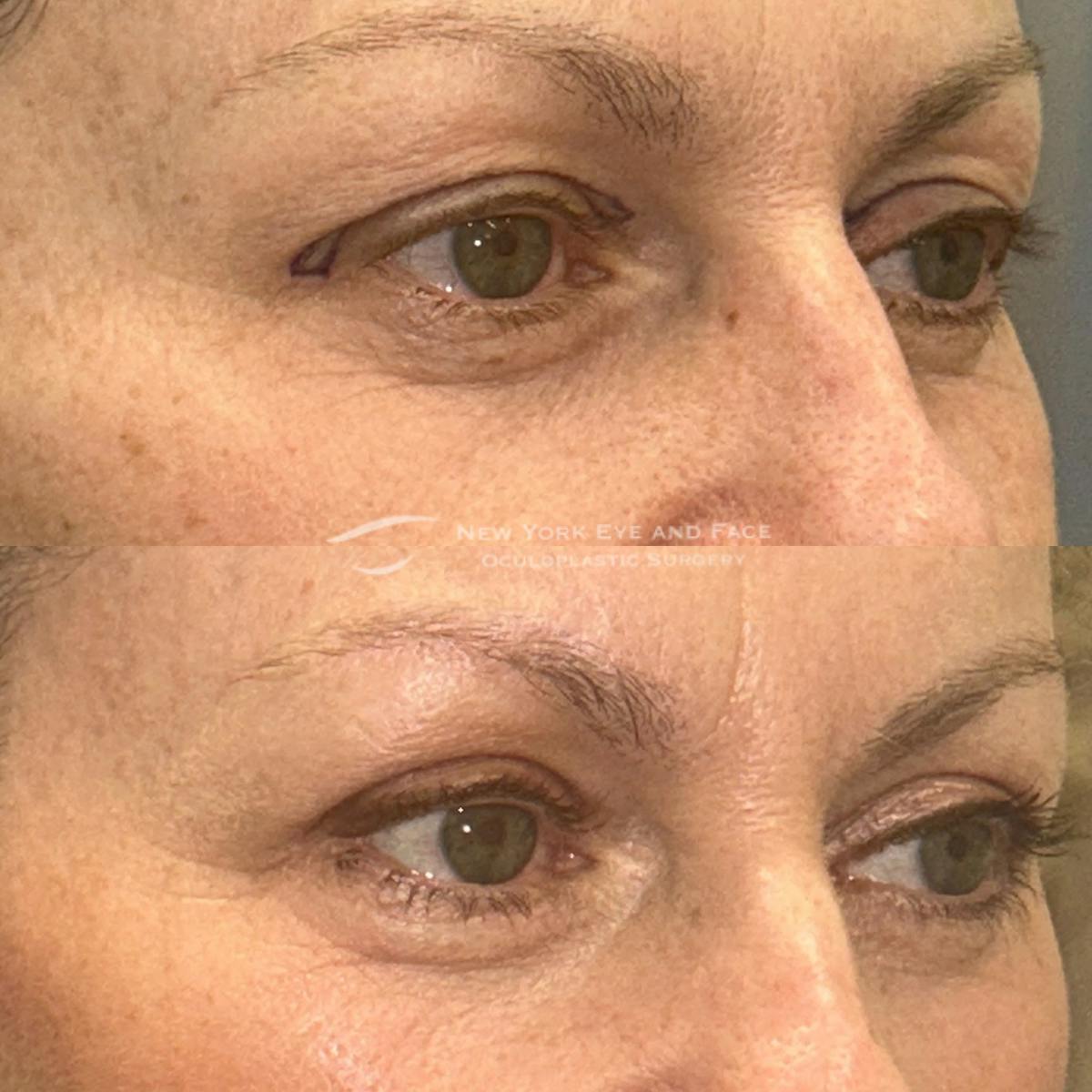 AcuPulse CO2 Laser Before & After Gallery - Patient 237285 - Image 2