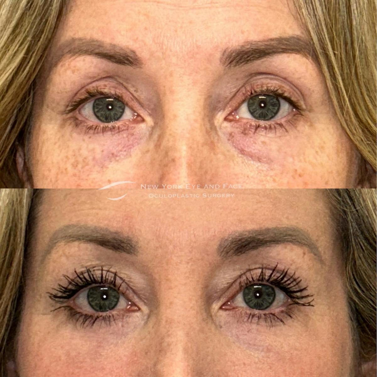 Lower Blepharoplasty Before & After Gallery - Patient 319955 - Image 1