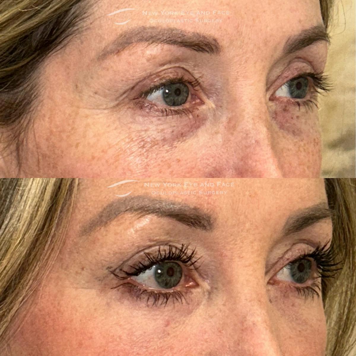 Lower Blepharoplasty Before & After Gallery - Patient 319955 - Image 2