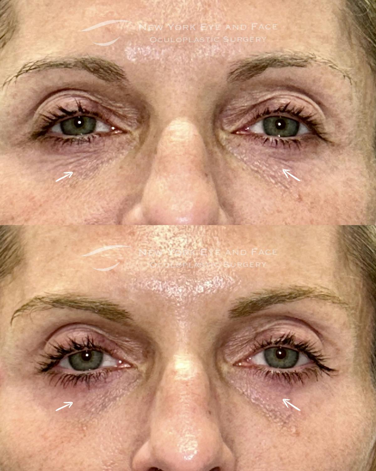 AcuPulse CO2 Laser Before & After Gallery - Patient 351416 - Image 1